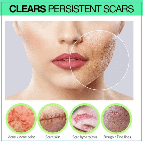 PRO niacinamidni serum za ožiljke - Slika 3