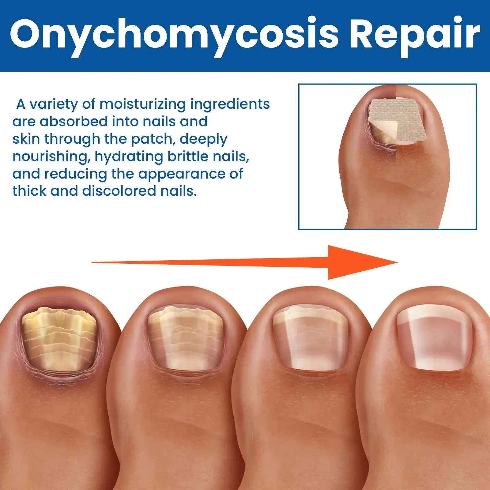 Flasteri za popravak gljivica na noktima - Slika 4